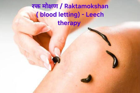 Raktamokshan is an Ayurvedic procedure aimed at blood purification and is considered one of the Panchakarma therapies. It's used to eliminate toxins that are believed to be the root cause of various diseases and health issues. Raktamokshan is a traditio