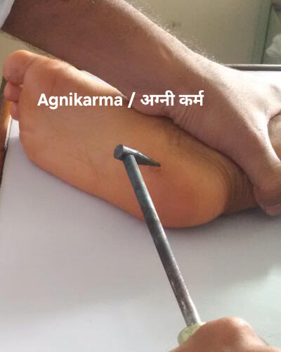 Agnikarma / अग्नी कर्म Agnikarma, also known as "Dahan karma," is an ancient Ayurvedic therapy that utilizes controlled heat burns to treat specific medical conditions. 1. Concept and Origin : - Agnikarma is based on Ayurvedic principles and dates back